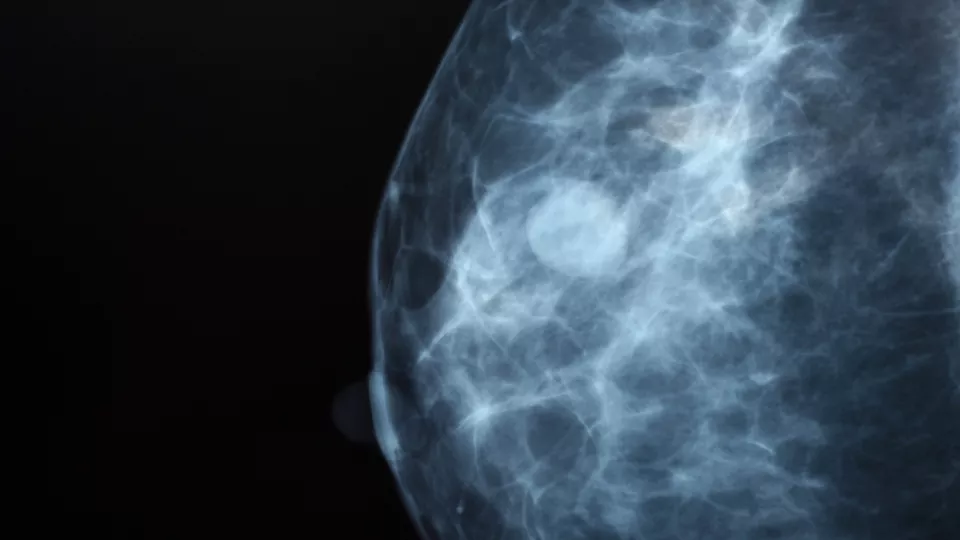 Breast screening image, photo: iStock