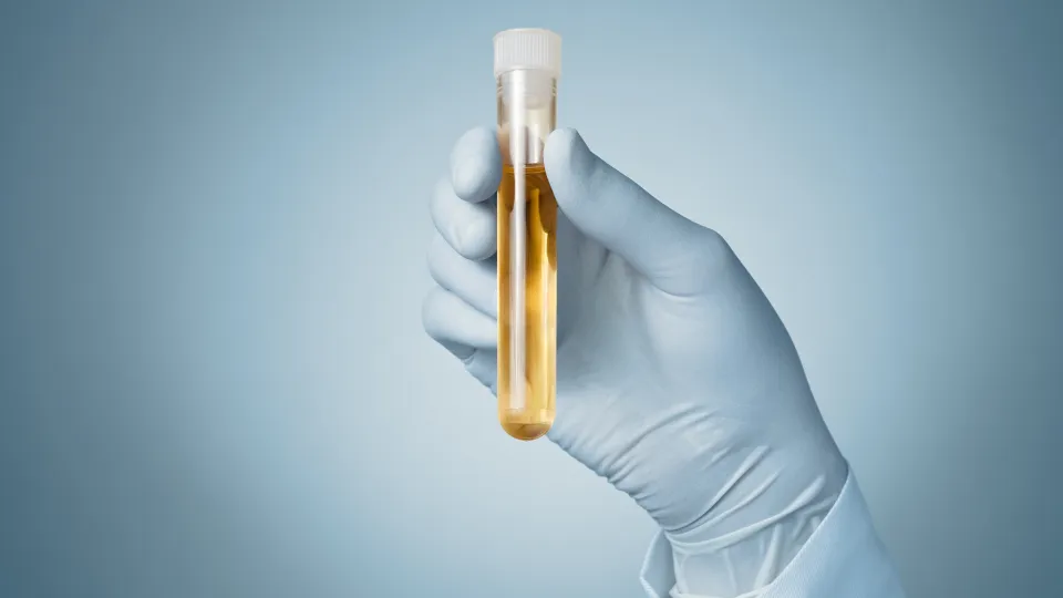 A gloved hand holding a test tube with urine, photography. Photo: iStock