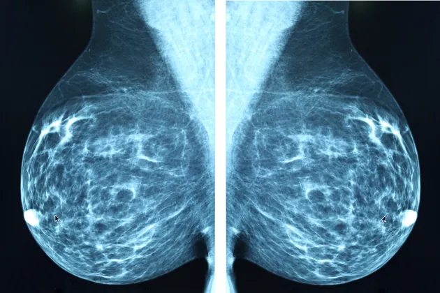 A mammography screening image. Photo: iStock